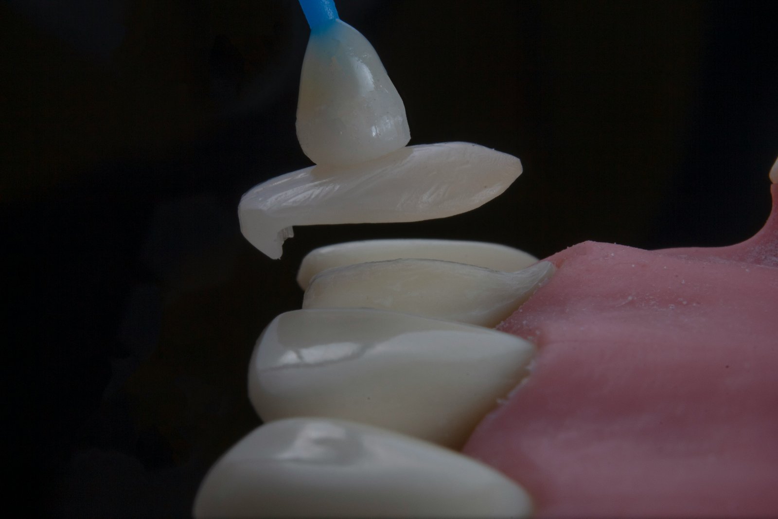 Implante unitário integrando-se ao sorriso